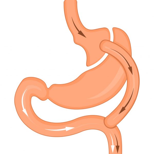 Copy of gastric bypass