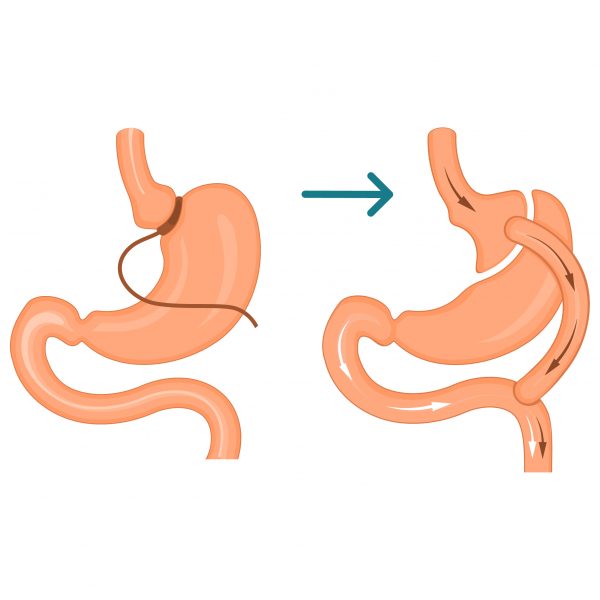 gastric band to bypass